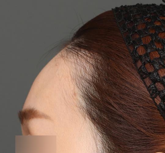 30代女性の額縮小 After 症例写真