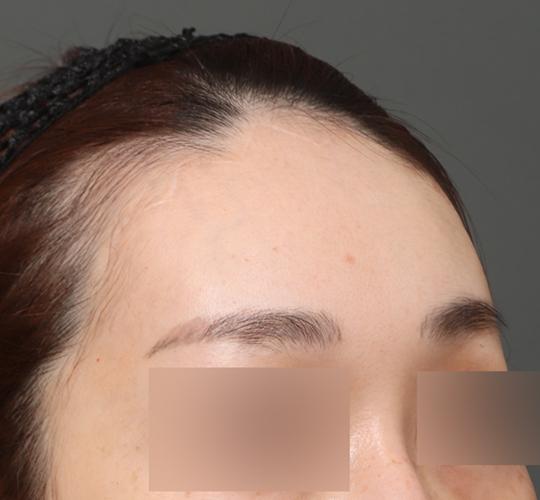 30代女性の額縮小 After 症例写真