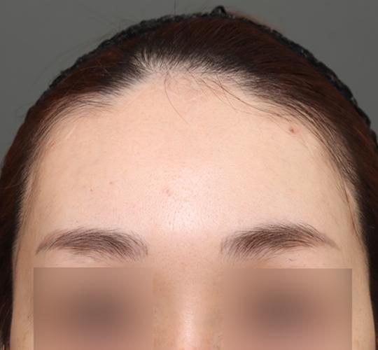 30代女性の額縮小 After 症例写真