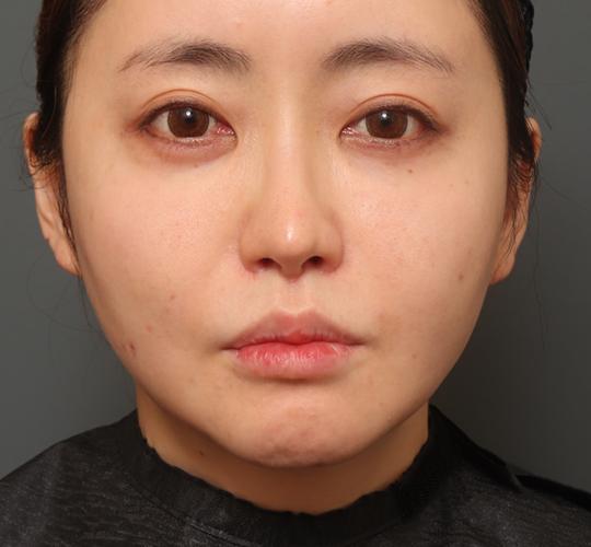 30代女性の鼻翼縮小（小鼻縮小） After 症例写真