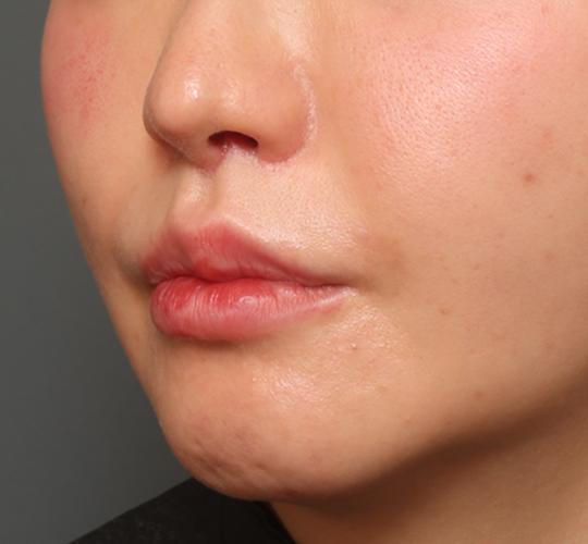 30代女性の人中短縮（リップリフト） After 症例写真