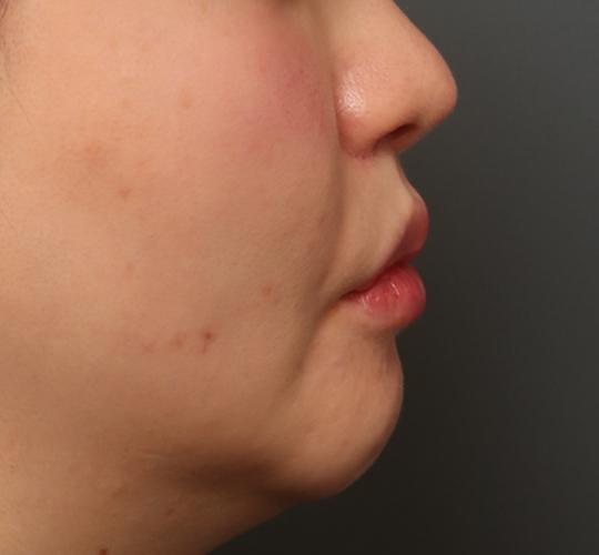 30代女性の人中短縮（リップリフト） After 症例写真