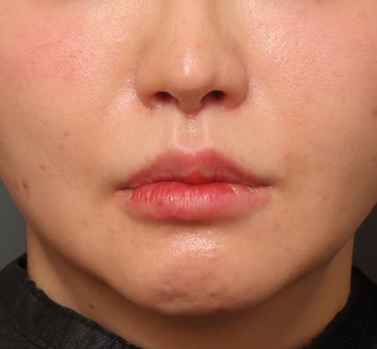 30代女性の人中短縮（リップリフト） After 症例写真