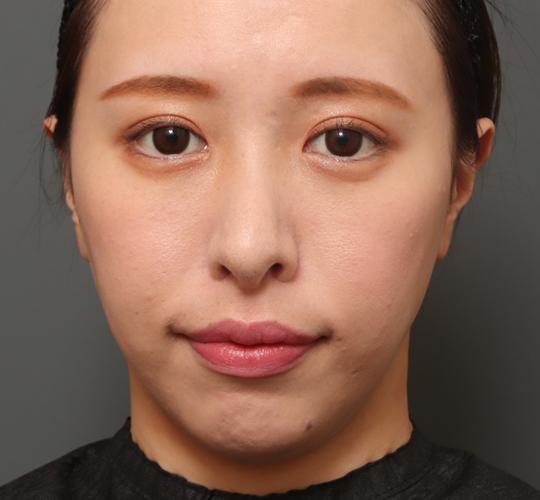 20代女性の人中短縮(リップリフト) After 症例写真