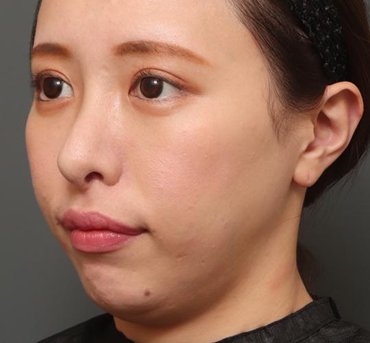 20代女性の人中短縮(リップリフト) After 症例写真