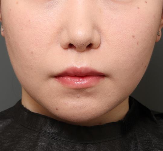 20代女性の鼻の整形 After 症例写真