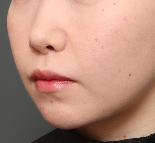 20代女性の人中短縮（リップリフト） After 症例写真