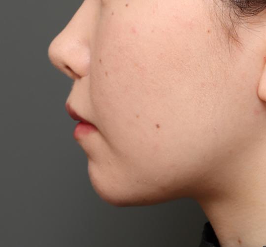 20代女性の人中短縮（リップリフト） After 症例写真