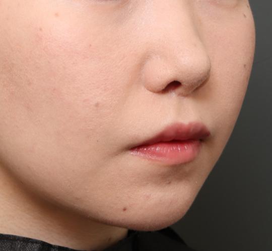 20代女性の人中短縮（リップリフト） After 症例写真