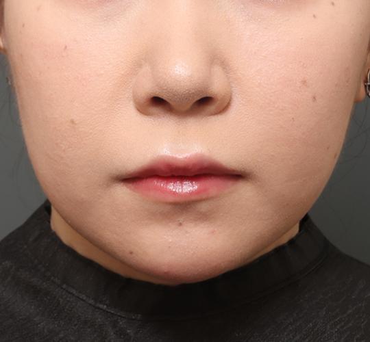 20代女性の鼻の整形 Before 症例写真