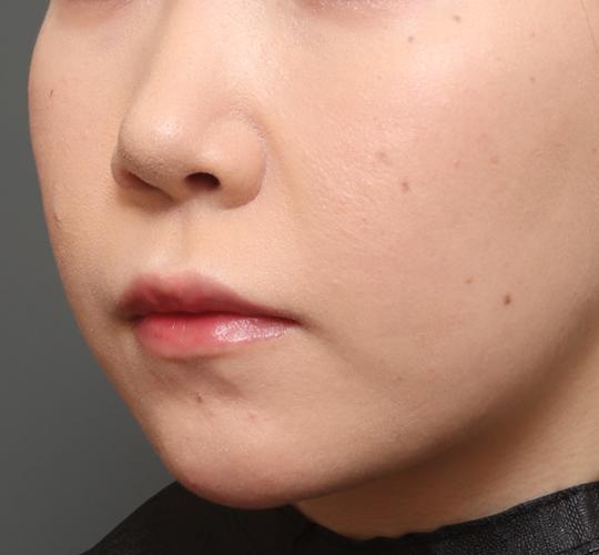 20代女性の人中短縮（リップリフト） Before 症例写真