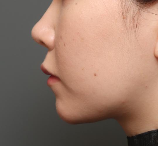 20代女性の人中短縮（リップリフト） Before 症例写真