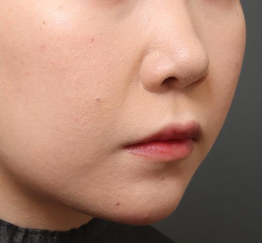 20代女性の人中短縮（リップリフト） Before 症例写真