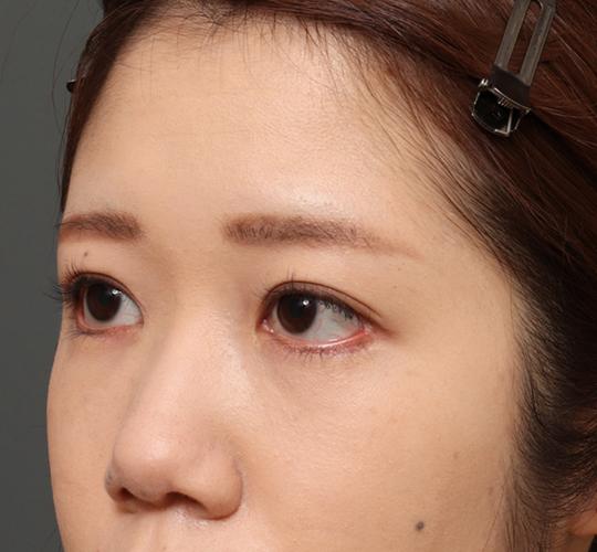 20代女性のタレ目・でか目形成 After 症例写真
