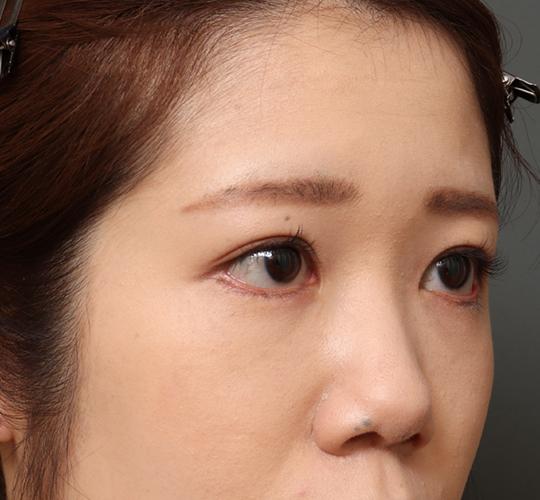 20代女性のタレ目・でか目形成 After 症例写真