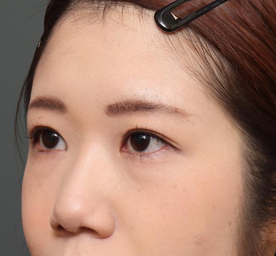20代女性のタレ目・でか目形成 Before 症例写真