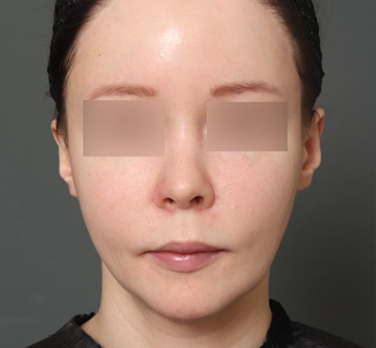 20代女性の二重アゴ筋肉縛り（ペリカン手術） After 症例写真