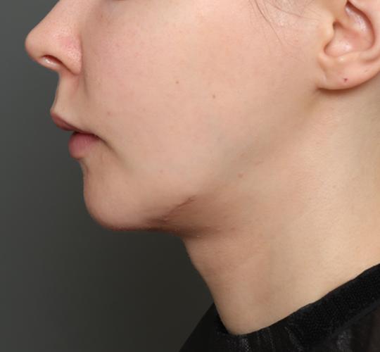 20代女性の二重アゴ筋肉縛り（ペリカン手術） After 症例写真