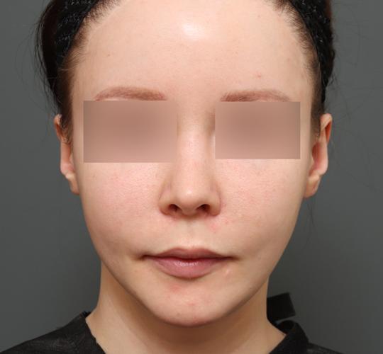 20代女性の二重アゴ筋肉縛り（ペリカン手術） Before 症例写真