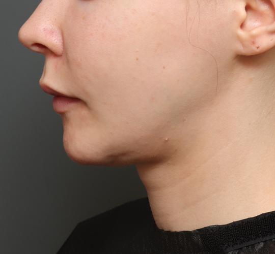 20代女性の二重アゴ筋肉縛り（ペリカン手術） Before 症例写真