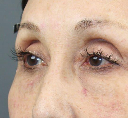 70代女性のアイスレッド After 症例写真