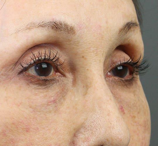 70代女性のアイスレッド After 症例写真