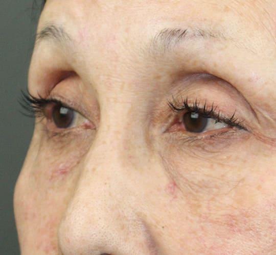 70代女性のアイスレッド Before 症例写真