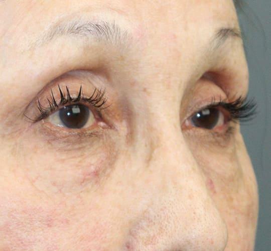 70代女性のアイスレッド Before 症例写真