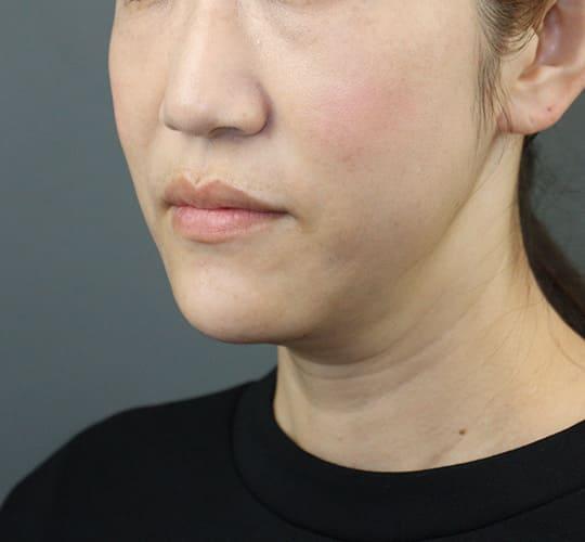 40代女性のVOVリフトプレミアム After 症例写真