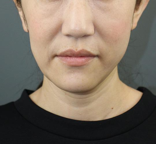 40代女性のVOVリフトプレミアム After 症例写真
