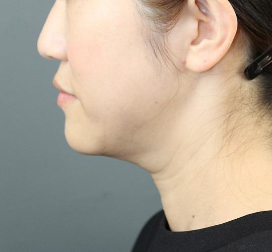 40代女性のVOVリフトプレミアム After 症例写真