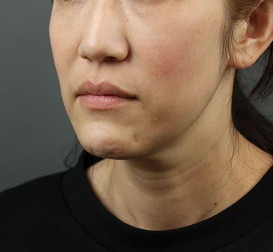 40代女性のVOVリフトプレミアム Before 症例写真