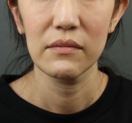 40代女性のVOVリフトプレミアム Before 症例写真