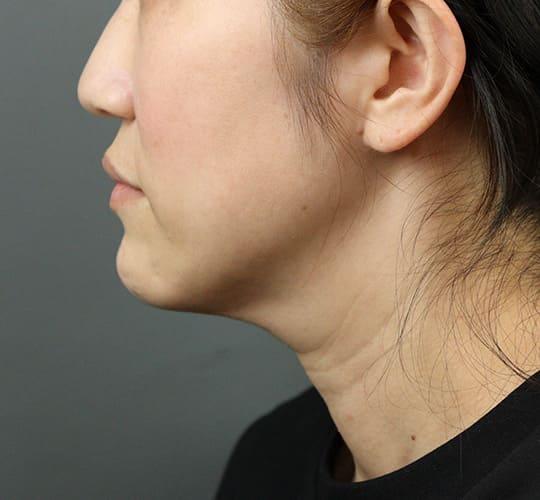 40代女性のVOVリフトプレミアム Before 症例写真