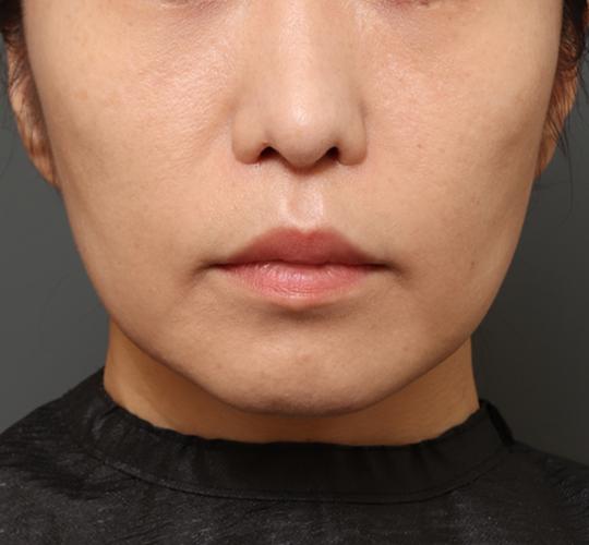 40代女性の唇・口元の整形 After 症例写真