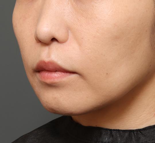40代女性の人中短縮(リップリフト) After 症例写真