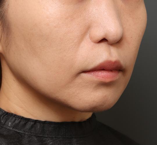 40代女性の人中短縮(リップリフト) After 症例写真