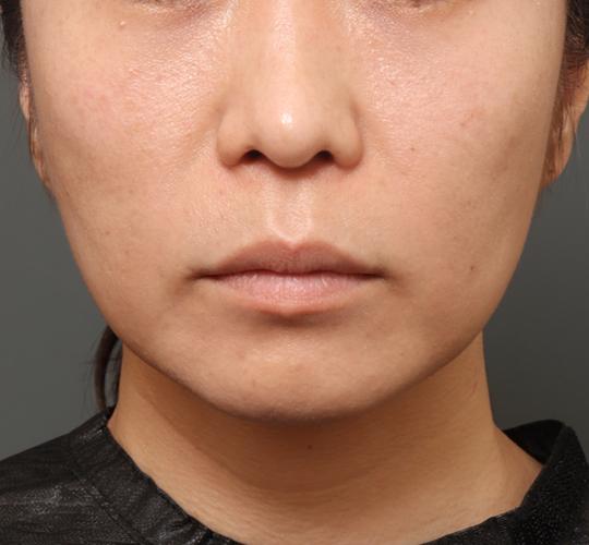 40代女性の唇・口元の整形 Before 症例写真