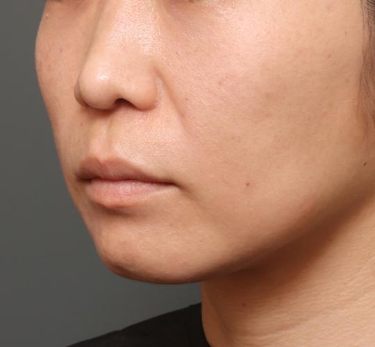 40代女性の人中短縮(リップリフト) Before 症例写真