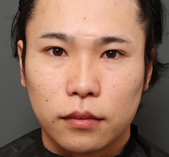 20代男性の人中短縮（リップリフト） After 症例写真