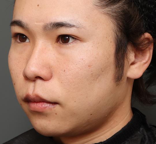 20代男性の唇・口元の整形 After 症例写真