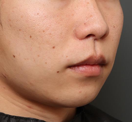 20代男性の人中短縮（リップリフト） After 症例写真