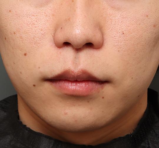 20代男性の人中短縮（リップリフト） After 症例写真