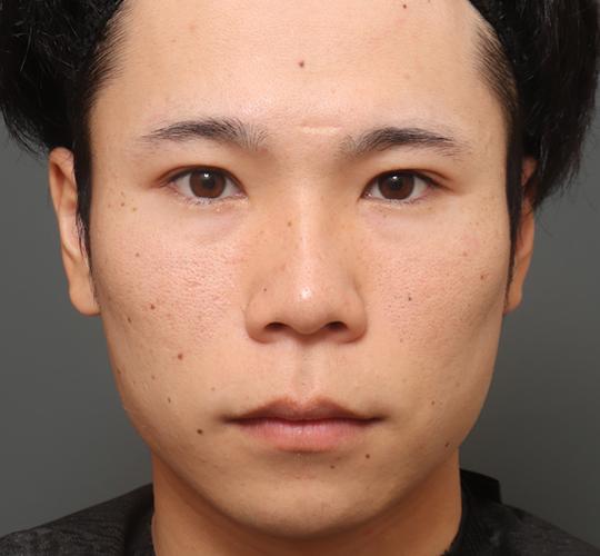 20代男性の人中短縮（リップリフト） Before 症例写真