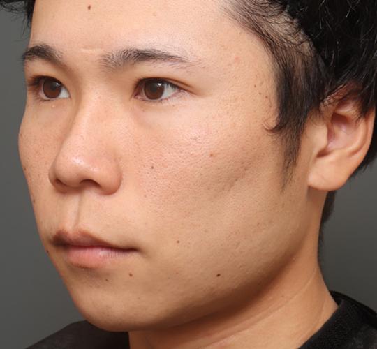 20代男性の唇・口元の整形 Before 症例写真