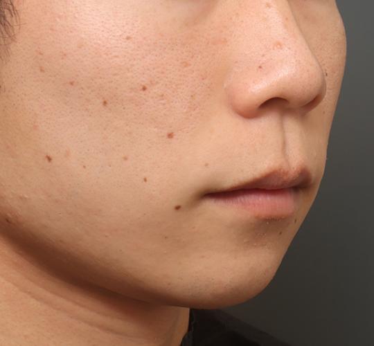 20代男性の人中短縮（リップリフト） Before 症例写真