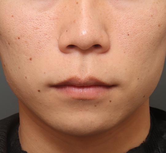 20代男性の人中短縮（リップリフト） Before 症例写真