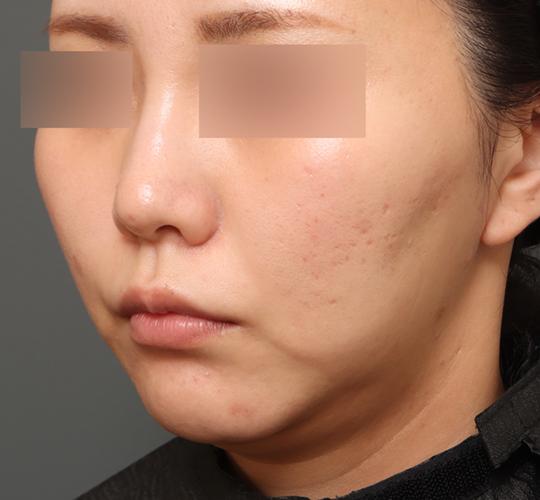 30代女性の脂肪吸引・痩身 Before 症例写真