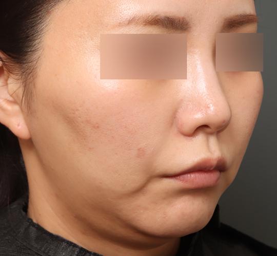 30代女性のフェイスタイト Before 症例写真