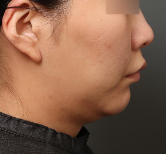 30代女性のフェイスタイト Before 症例写真